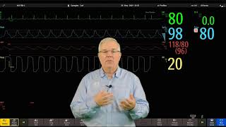 Philips IntelliVue Patient Monitoring  5  Changing Alarm Limits [upl. by Hgieloj]