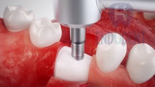 Colocación de implantes dentales paso a paso vídeo animado [upl. by Ortrud]