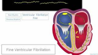 ECG Rhythm Review Coarse and Fine Ventricular Fibrillation [upl. by Anayeek]