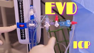 External Ventricular Drainage EVD and ICP Monitoring [upl. by Nylatsirhc]