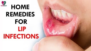 Home Remedies For Of Lip Infections  Health Sutra [upl. by Aicinod]