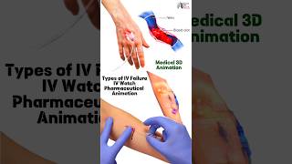 Types of IV Failure IV Watch Pharmaceutical Animation medical animation3d short BiologywithAliya [upl. by Thinia658]