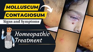 Molluscum contagiosum  Signs and Symptoms  Causes  Homeopathic Treatment of Molluscum Contagiosum [upl. by Ced984]