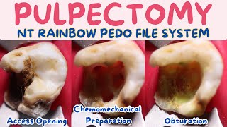 Pulpectomy🟢maxillary molar with distal caries ⚪️access opening🟡CMP🔵obturation🟣NT rainbow🌈 Pedo files [upl. by Hirai]