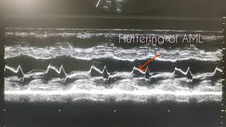 Mild AR can cause fluttering of AML [upl. by Ortiz]