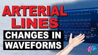 Common Changes in Arterial Line Waveforms [upl. by Wales]