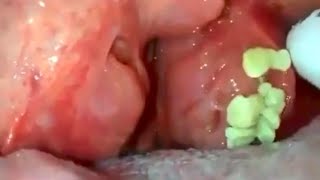 big tonsils stones removal tonsilolith removal big hidden tonsils stone removal [upl. by Stafani]