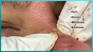 Big Cystic Acne Blackheads Extraction Blackheads amp Milia Whiteheads Removal Pimple Popping [upl. by Ney]