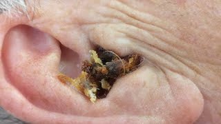 Ear Wax Removal Ear Wax Cleaning [upl. by Amado]