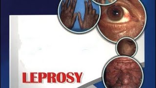 Leprosy and NTM  Diagnosis Treatment  MICROBIOLOGY [upl. by Alexander]