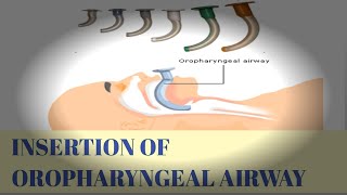 INSERTION OF OROPHARYNGEAL AIRWAYGUEDEL AIRWAY [upl. by Ribak]