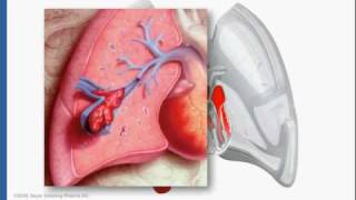 IVC Filters [upl. by Vescuso]