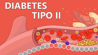 Diabetes tipo 2  Explicada Fácilmente Para Pacientes [upl. by Nrojb706]