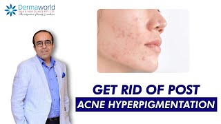 How to get Rid of Acne Hyperpigmentation  Advice from Dermatologist [upl. by Amluz]