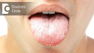 Causes and symptoms of oral thrush  Dr Jayaprakash Ittigi [upl. by Vachill719]