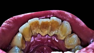 Deep Cleaning With HEAVY Tartar Build Up At The Dentist [upl. by Tnirb]