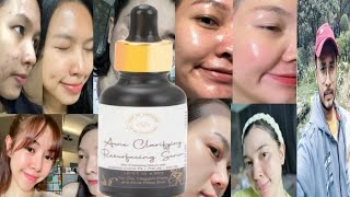 Pure By Priyanka Acne Clarifying Resurfacing Serum  Honest Review [upl. by Onirefez411]