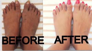 💖  Astuce Naturel  Comment Éclaircir les Pieds noirs en 7 jours 💯  Garantie 🎉 [upl. by Mckenna]