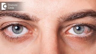 Causes of Red eye  Dr Mala Suresh [upl. by Nahtan399]