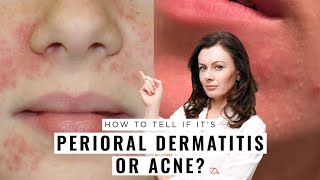 Perioral Dermatitis or Acne How to Tell the Difference  Dr Sam Bunting [upl. by Saravat]