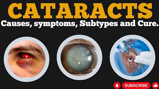 5 Surprising Causes and Treatments for Cataracts Revealed [upl. by Seumas602]