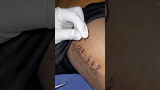 Post Surgery Stitches Removal satisfying stiches postsurgery accident inspirational emotional [upl. by Nonrev]