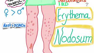 Erythema Nodosum [upl. by Llednav739]