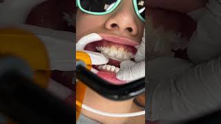 How Braces are Put On [upl. by Odrick]