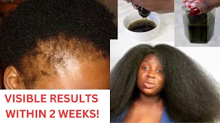 🔥🔥Starting From Scratch Your Hair Will Never Stop Growing Make This If Your Hair Growth Is Slow [upl. by Malvie]