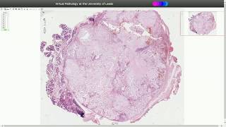 Pleomorphic Adenoma  Histopathology [upl. by Pesvoh]