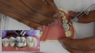 Amalgam Fill Restoration Walkthrough tutorial  Simulation Clinic Demonstration [upl. by Cand]