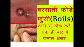 बरसाती फोड़े फुंसी ठीक करेंदाग भी होंगे साफ़  Boils Best Treatment [upl. by Jane]