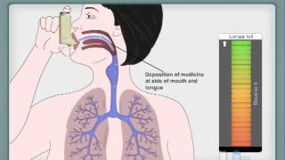 How to use Asthma inhaler  MDI [upl. by Erastatus157]