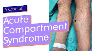 Acute Compartment Syndrome [upl. by Ymmas]