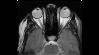 Eye movement during MRI [upl. by Liana278]