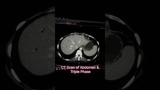 CT Scan of Abdomen amp Triple Phase [upl. by Darb]