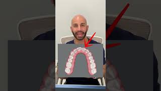 Quick Invisalign Case Study 2024 [upl. by Nahta271]