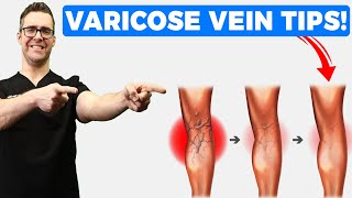 Best Varicose Vein Home Treatments Top 25 Spider Veins Remedies [upl. by Airyt]