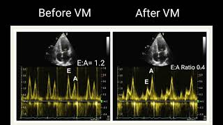 All about LV Diastolic Dysfunction Echocardiography Basics [upl. by Amsirahc]