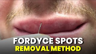 How to get rid of fordyce spots on lips with home remedies – Small white bumps treatment [upl. by Apple682]