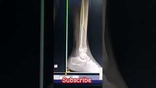 Left Leg fracture Xray shorts viral medical student supporttrending craft me [upl. by Kalli637]