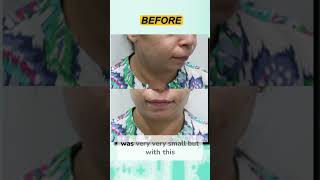 Chin Implants Instant Jawline Upgrade [upl. by Llevart]