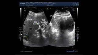 Ultrasound Video showing the difference between the Stone and Sludge in Gall Bladder [upl. by Leval]