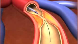 Percutaneous coronary Intervention stenting [upl. by Lias917]