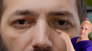 1 Vitamin to Remove Dark Circles  Dr Mandell [upl. by Rillis85]