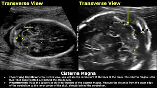 How To Measure Fetal Cisterna Magna On Ultrasound  Fetal Brain Anomaly Scan  Obstetric USG [upl. by Ytomit]