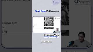 Skull Base Pathologies By DrZainab Vora [upl. by Sudnac]