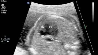 FETAL TRICUSPID ATRESIA DR GAURAV AGRAWAL [upl. by Yseulta]