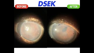 DSEK for bullous keratopathy [upl. by Ahsitniuq]