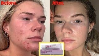 Acnesol Gel For Permanent Acne Pimples Removal 🔥  Usefull Products [upl. by Kassel941]